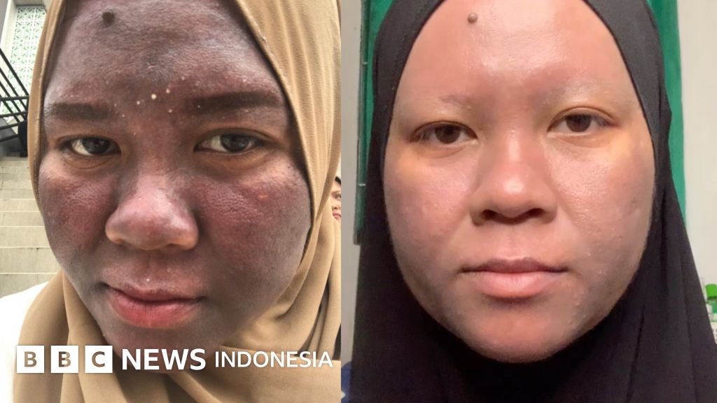 Apa yang Terjadi di Kulit Warga Cilacap? 5 Penyakit yang Sering Diabaikan